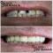 riabilitazione full arch superiore in ceramica